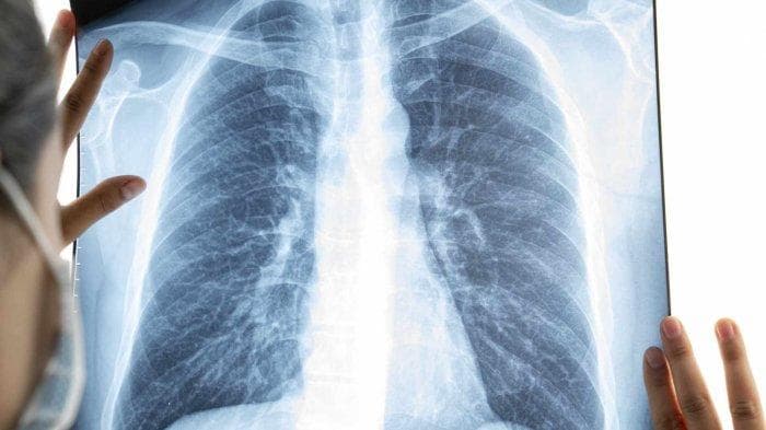 Dinkes Catat Pengidap TBC di Aceh Diperkirakan Capai 21 Ribu Kasus